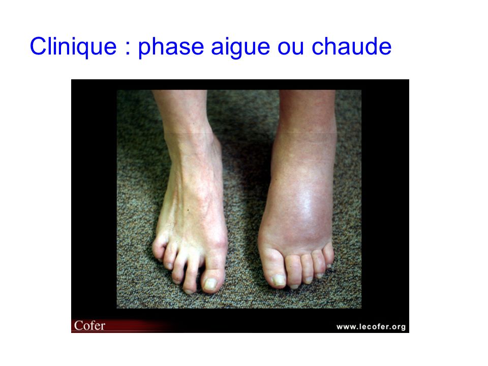 Diagnostic et traitement d une algodystrophie du pied chez l